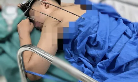 Nam sinh 17 tuổi bị cây đinh ba đâm xuyên tim phổi thoát chết kì diệu