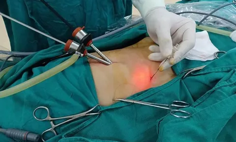 Người phụ nữ nguy kịch vì viên sỏi mật bé xíu 'trở chứng' dù sống chung nhiều năm qua