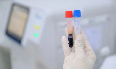 29 tuổi, mỡ máu cao vút dù ăn uống khoa học, cân nặng bình thường: Không ngờ lý do là điều này