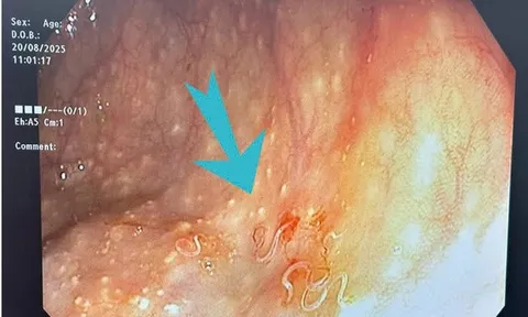 Người phụ nữ đi khám vì đau bụng dữ dội, bác sĩ sốc nặng khi thấy thứ đáng sợ bên trong