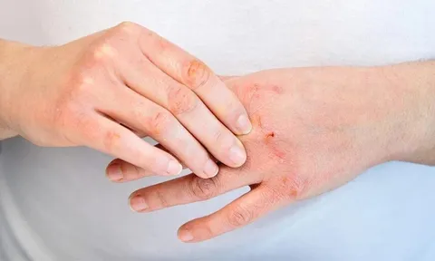 Mưa bão, lụt lội: Cẩn trọng với nguy cơ bỏng và mắc các bệnh về da