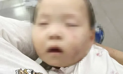 Tạm giữ nữ giáo viên trong vụ bé gái có nhiều vết bầm tím chi chít trên mặt