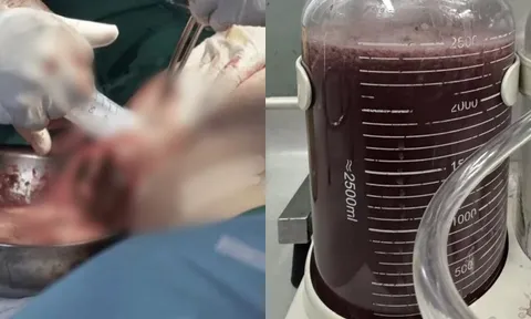 Rùng mình: Người phụ nữ TP.HCM bị áp-xe ăn mòn sau mũi tiêm filler nâng mông, bác sĩ sốc khi hút ra 2,5 lít dịch mô hoại tử