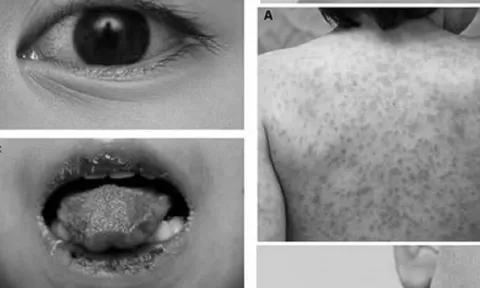 Trẻ mắc bệnh hiếm gặp gây đột tử, bác sĩ chẩn đoán bị... viêm họng