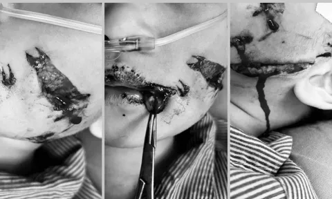 Cháu bé 5 tuổi bị chó cắn rách mặt khi đang chơi ở nhà