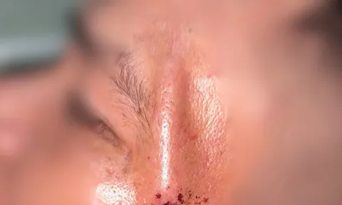 Người đàn ông nhập viện với khúc cây xuyên vào thái dương