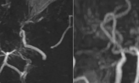 Hình ảnh MRI khiến bác sĩ bất ngờ: Mạch máu não bệnh nhân mờ như "khói thuốc"