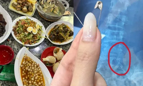 Đi ăn ốc, cô gái nuốt cả chiếc kim băng đang mở vào bụng, phải mổ cấp cứu 6 tiếng, tốn 70 triệu