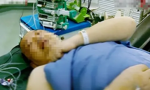 Mắc bệnh tim sau 1 năm chạy bộ mỗi sáng, nguyên nhân gây bất ngờ