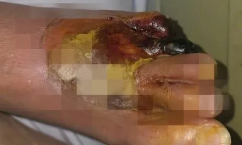 Bàn chân bị cháy đen vì sưởi ấm bằng máy sấy tóc