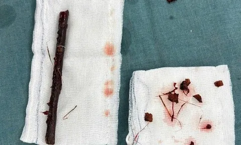 Hy hữu nhành cây dài 16 cm nằm trong bụng bé gái suốt 4 tháng