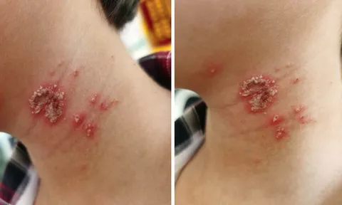 Bé trai 10 tuổi bỗng xuất hiện những nốt mẩn lạ trên da nhưng vẫn chưa tìm ra được nguyên nhân