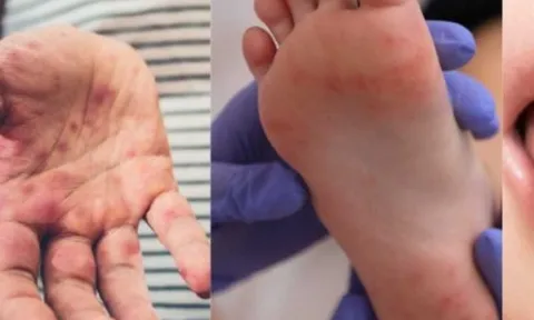 Bệnh tay chân miệng ở trẻ em: Dấu hiệu, nguyên nhân và cách điều trị