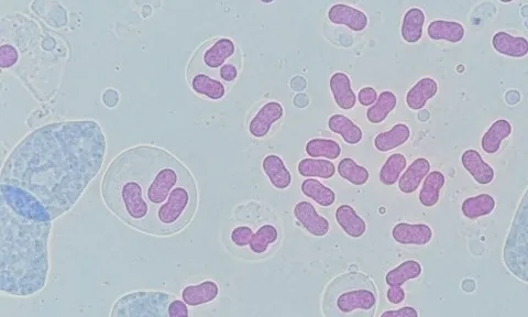 Hà Nội ghi nhận ca mắc não mô cầu là trẻ 11 tuổi, chưa tiêm vaccine