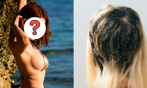 Nữ DJ suy sụp bật khóc, tóc rụng mảng lớn