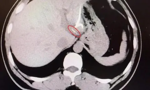 Người đàn ông 37 tuổi suýt mất nửa lá gan vì ăn cá