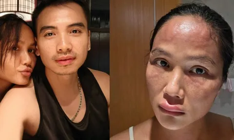 Hoa hậu H'Hen Niê sau khi bị biến dạng mặt