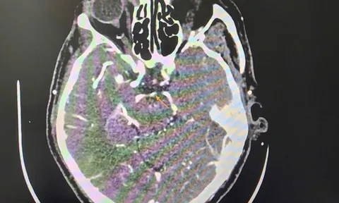 Đột quỵ khi uống bia, người đàn ông thoát chết ngoạn mục