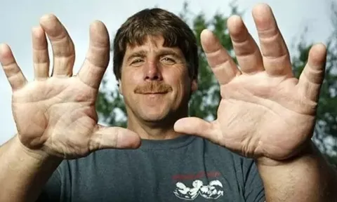 Người đàn ông sở hữu bàn tay to bất thường, sự thật phía sau khiến tất cả kinh ngạc