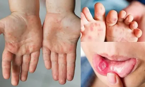 Nguy cơ dịch chồng dịch ở TP.HCM, ghi nhận hơn 3.000 ca một tuần