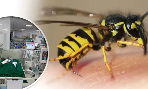 Bé gái 9 tuổi nguy kịch vì bị đàn ong vò vẽ đốt hơn 50 nốt