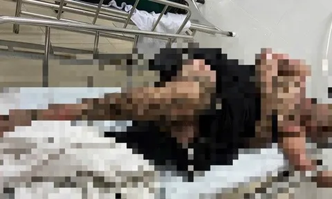 Bị bỏng toàn thân khi quăng câu vướng vào dây điện