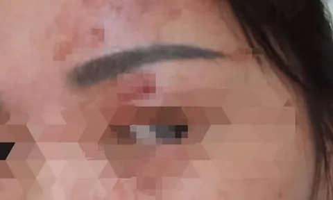 Người phụ nữ bỏng giác mạc vì làm 1 việc khi giặt đồ