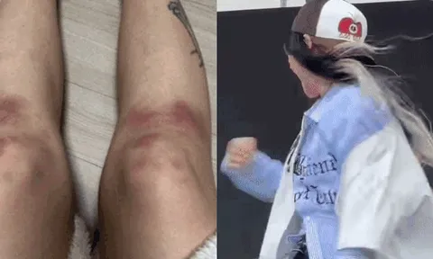 Nữ rapper 96 tung ảnh bị bạn trai đánh bầm dập đến mức hủy show, đàng trai hùng hổ phốt ngược gây phẫn nộ