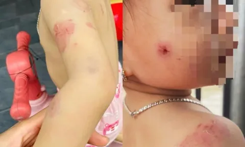 Phụ huynh bức xúc khi con gái hơn 2 tuổi chi chít vết cắn trên người sau giờ học