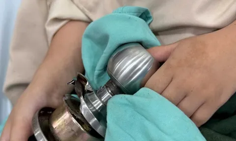 Bệnh nhi ‘ôm’ ổ khóa nhập viện cấp cứu, bác sĩ phát cảnh báo khẩn