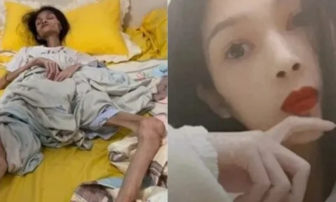 Nữ Tiktoker 27 tuổi qua đời vì chứng teo dạ dày, lúc cuối đời chỉ còn 17,5 kg: Mọi chuyện bắt đầu từ hoàn cảnh gia đình