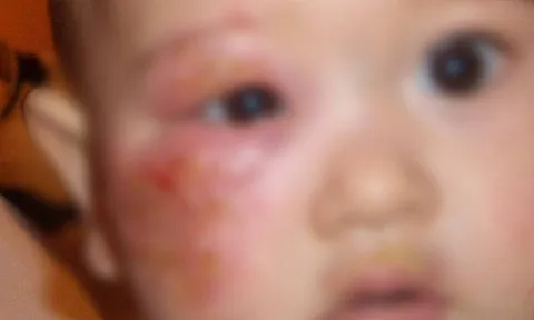 Bé gái 4 tuổi mắc giang mai - nguồn lây không ngờ từ một thói quen cho cháu ăn của bà nội