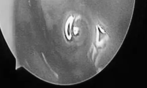 Bé trai hơn 2 tuổi chảy mũi hàng ngày, bác sĩ phát hiện ra "bí mật" đáng sợ