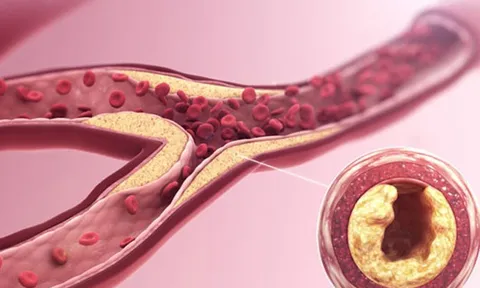 3 "kẻ thù" giấu mặt đang âm thầm bóp nghẹt mạch máu mỗi ngày, đột quỵ dễ ập đến bất ngờ