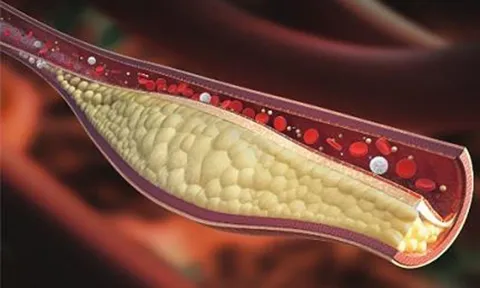 Máu nhiễm mỡ nguy hiểm thế nào?