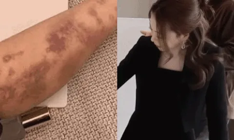 Sao nữ xinh như tiên tỉnh dậy hoảng loạn thấy toàn thân bầm tím sau khi tiêm thuốc bổ tại bệnh viện