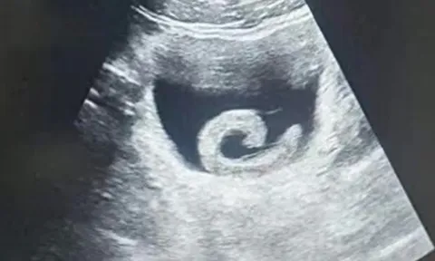 Đi siêu âm, người đàn ông sốc nặng khi thấy con vật "bơi" trong bụng mình
