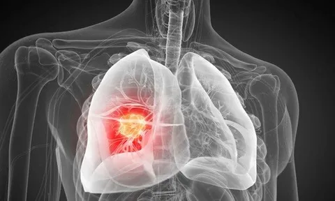 Phát hiện nguyên nhân gây ung thư phổi chưa từng biết