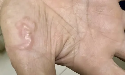 Thường xuyên ăn món "vạn người mê", cô gái trẻ sốc khi biết nhiễm 4 loại ký sinh trùng