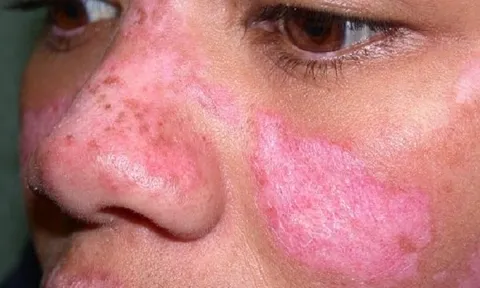 Cô gái Huế đột ngột qua đời trước ngày cưới nửa tháng do mắc bệnh lupus ban đỏ: Cảnh báo 1 nhóm phụ nữ nguy cơ cao mắc bệnh