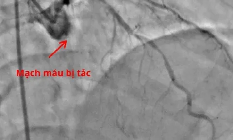 Chết lâm sàng vì bỏ qua dấu hiệu cảnh báo nhồi máu cơ tim cấp