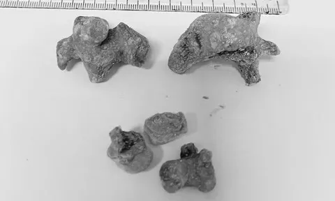 Đau quặn bụng dữ dội, người phụ nữ 55 tuổi phát hiện bí mật đáng sợ