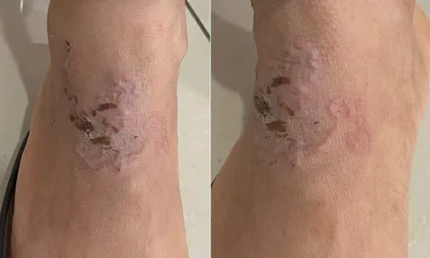 Sinh vật "đào đường hầm" ngoằn ngoèo dưới da người phụ nữ: Bác sĩ chỉ đích danh thủ phạm