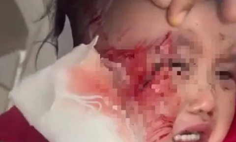 Sập trần thạch cao giờ ngủ trưa, một trẻ mầm non bị thương nặng