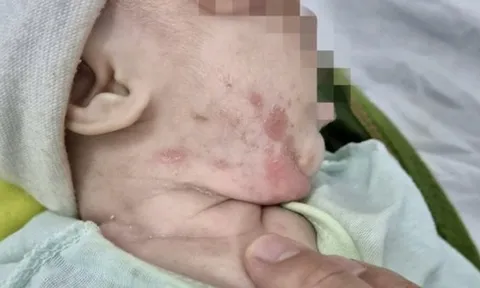 Bệnh lây qua đường tình dục gia tăng, trẻ sơ sinh cũng mắc