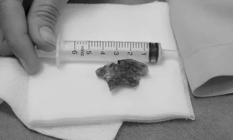 Nửa đêm đau họng, người phụ nữ 55 tuổi phát hiện bí mật "đáng sợ"