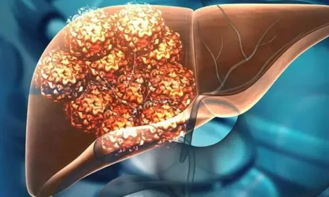 Khối u gan 6 cm đột nhiên biến mất sau khi chuyện này xảy ra