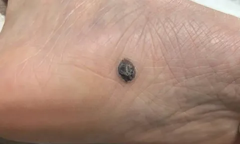 5 dấu hiệu nốt ruồi có thể là ung thư da, dấu hiệu số 1 dễ bị bỏ qua