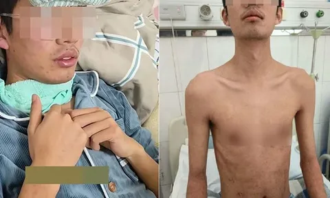 25 tuổi phát hiện ung thư gan giai đoạn cuối, bác sĩ xót xa: 3 sai lầm đang âm thầm “hủy hoại” lá gan nhiều người mắc phải