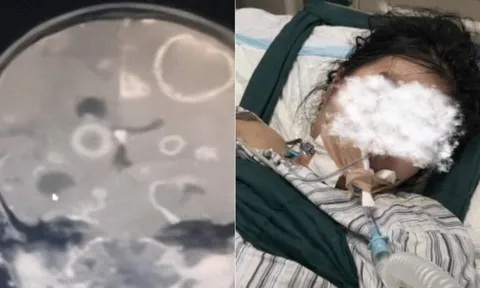 Dọn dẹp nhà đón Tết, bé gái lớp 2 bị "ăn mòn 20 lỗ thủng" ở não